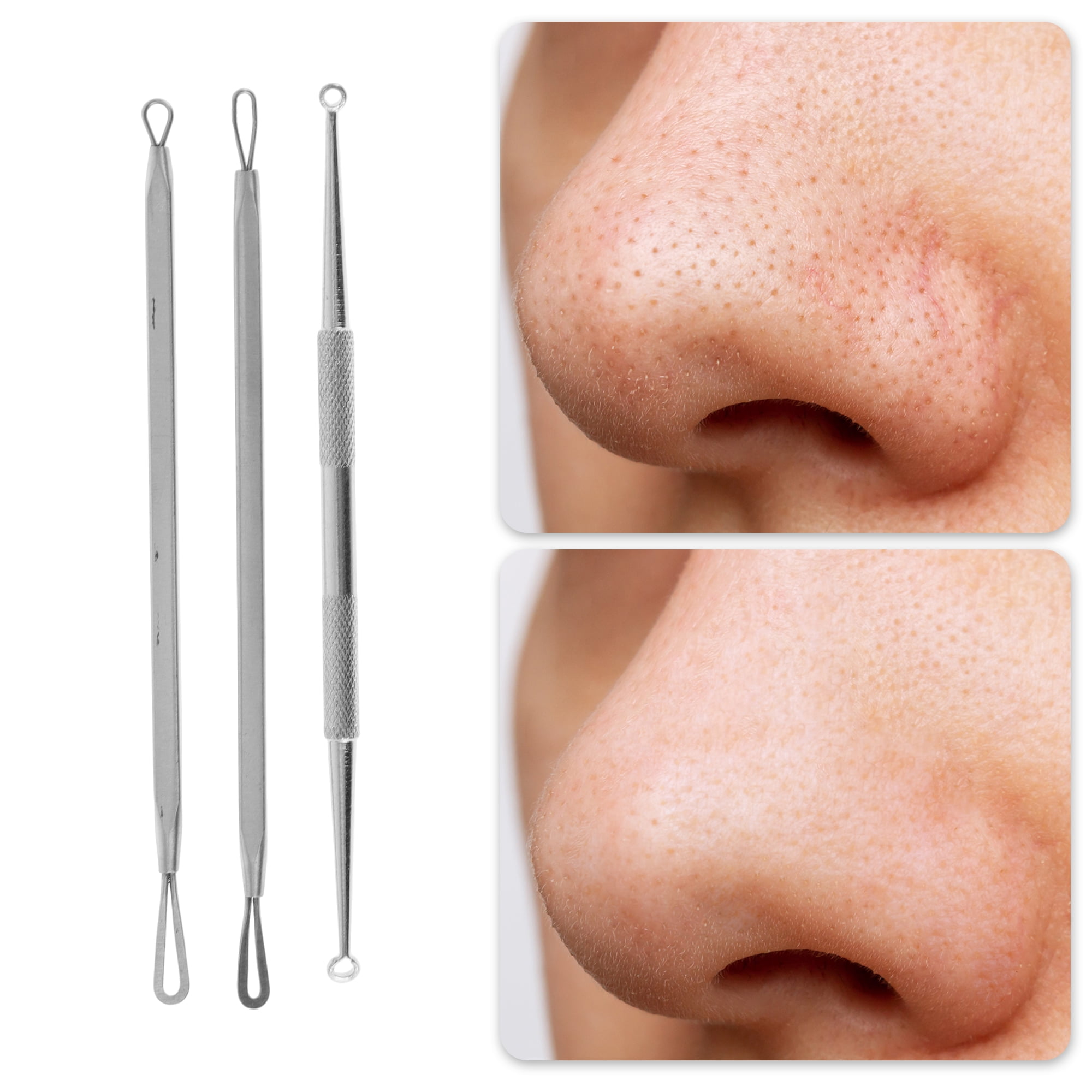 Alat Ekstraktor Jerawat Profes - Beauty & Makeup Katia Di Paola Palermo ulasan dan harga